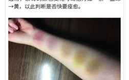 女性为何更易患淤青之谜