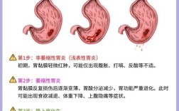 26岁女生胃癌疑因幽门螺旋杆菌感染