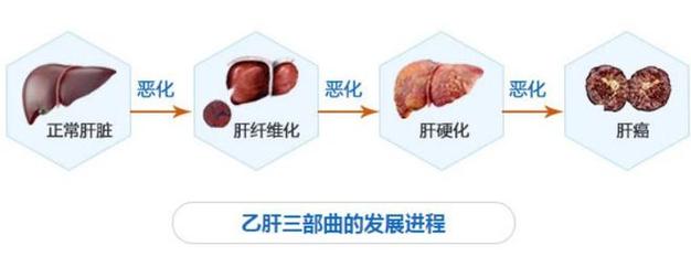 中国年轻人群面临的第一大肝病威胁加剧-图2