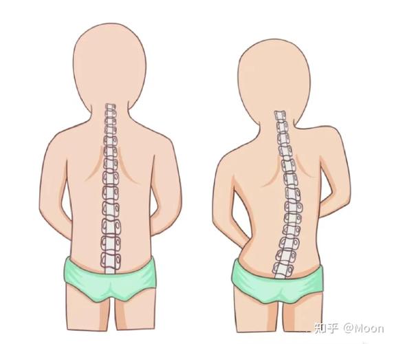 儿童坐姿不端正或与脊柱侧弯有关-图3 儿童坐姿不端正或与脊柱侧弯有关-图3