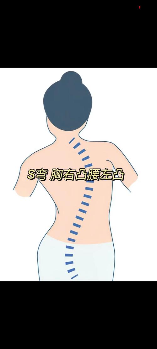 儿童坐姿不端正或与脊柱侧弯有关-图2 儿童坐姿不端正或与脊柱侧弯有关-图2