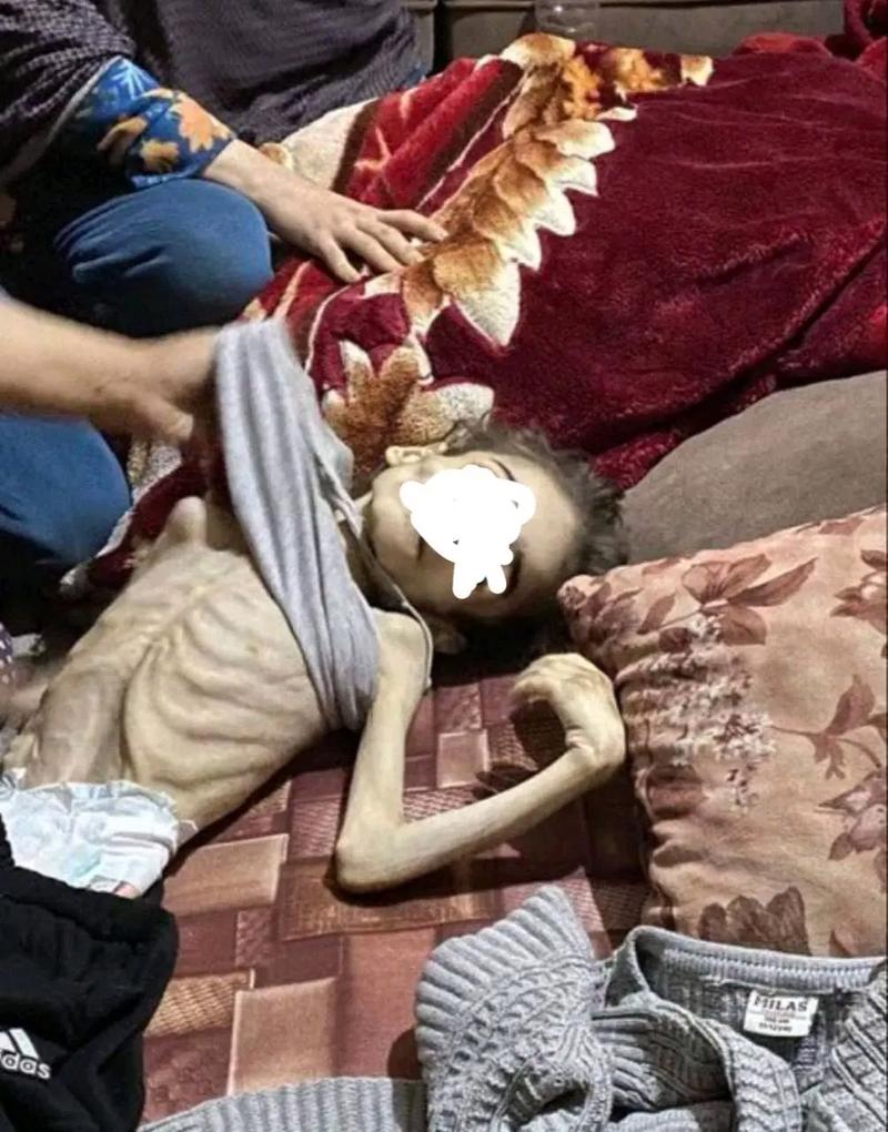 加沙5岁男童饥饿离世，体重仅3公斤引发关注-图2