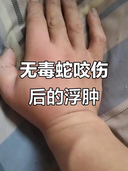 紧急自救，被蛇咬后能否用嘴吸出毒血？-图3