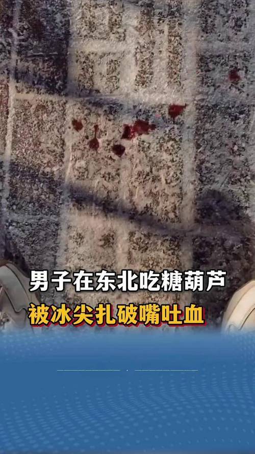 22岁辣食爱好者因过度辛辣饮食引发肠道大出血-图2