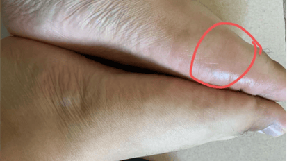 火锅汤成痛风陷阱，小伙豪饮后痛不欲生-图2