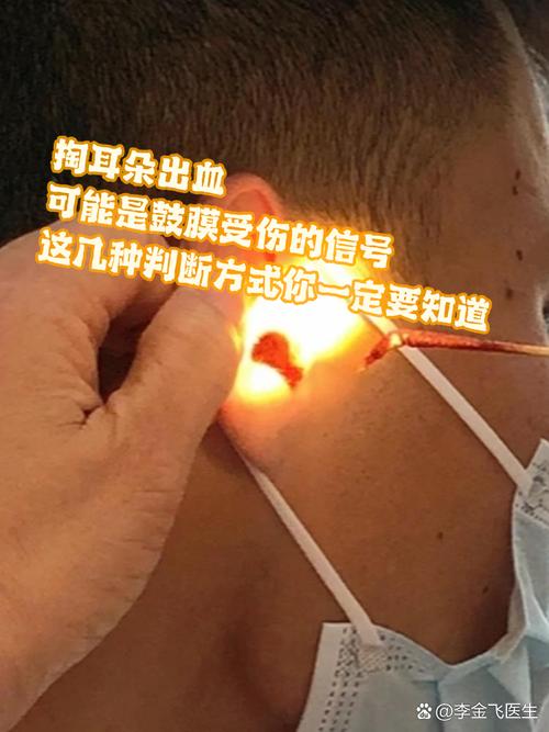 爸爸掏耳朵意外受伤,孩子不慎撞落耳膜-图1 爸爸掏耳朵意外受伤,孩子不慎撞落耳膜-图1