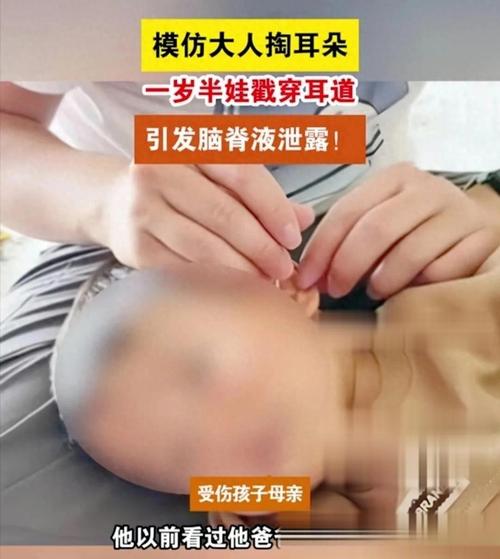 爸爸掏耳朵意外受伤,孩子不慎撞落耳膜-图2 爸爸掏耳朵意外受伤,孩子不慎撞落耳膜-图2