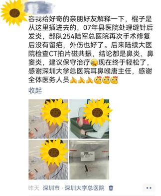 多年鼻窦炎原因竟是树枝藏鼻中-图1 多年鼻窦炎原因竟是树枝藏鼻中-图1