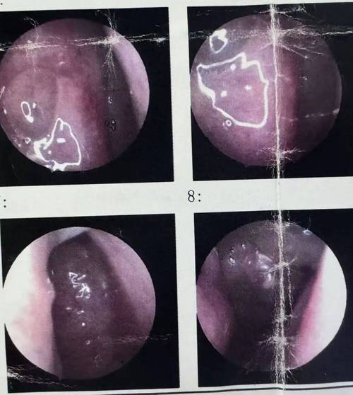 多年鼻窦炎原因竟是树枝藏鼻中-图3 多年鼻窦炎原因竟是树枝藏鼻中-图3