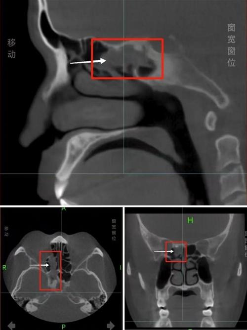 多年鼻窦炎原因竟是树枝藏鼻中-图2 多年鼻窦炎原因竟是树枝藏鼻中-图2