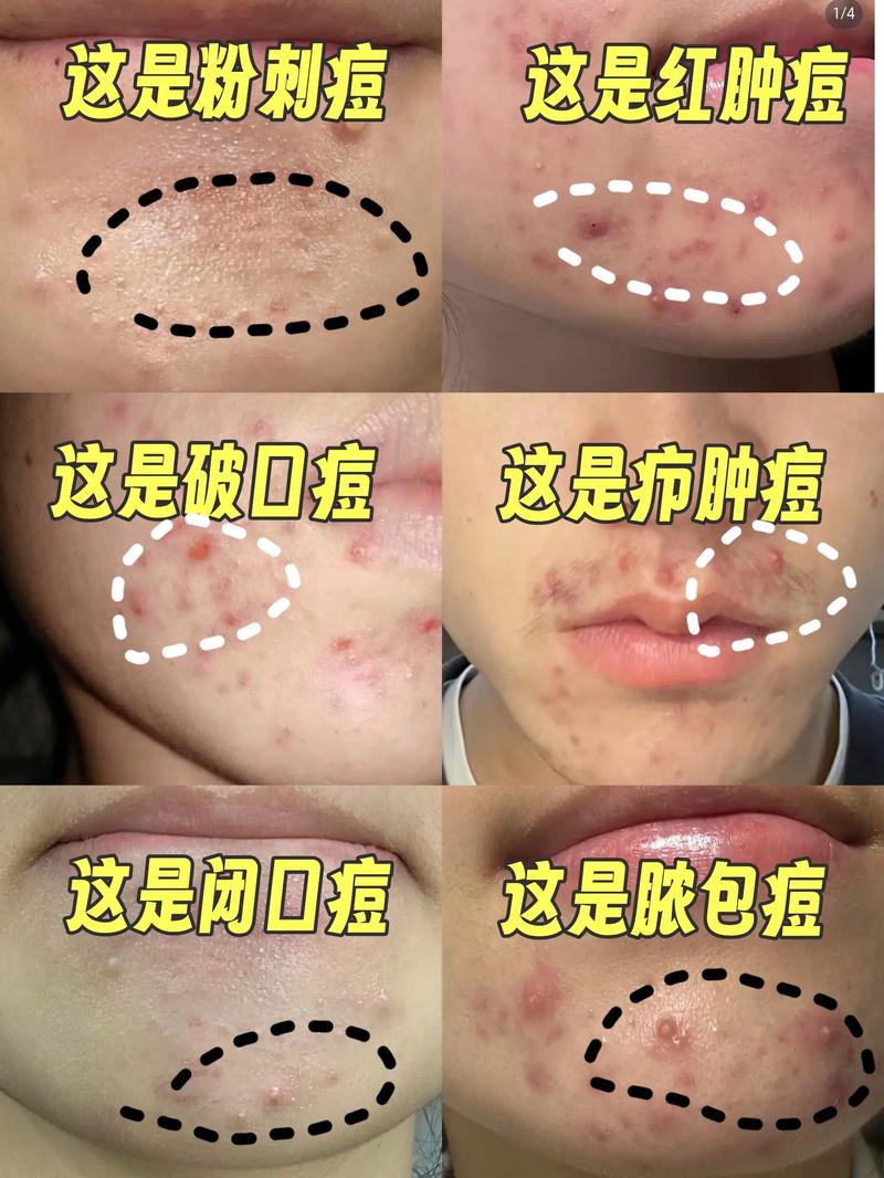 面部痘痘视频剪辑教程,打造专业护肤教学视频-图3 面部痘痘视频剪辑教程,打造专业护肤教学视频-图3