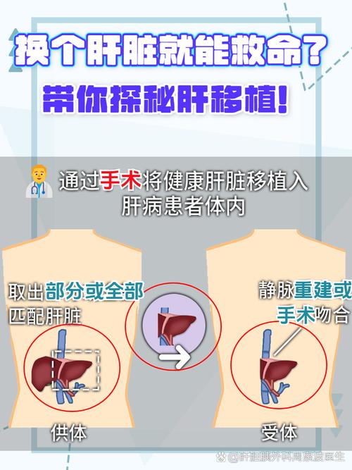 重庆实现首例成人亲体辅助肝移植成功-图2