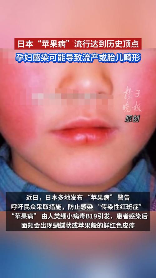 日本苹果病肆虐，历史新高点来袭-图1