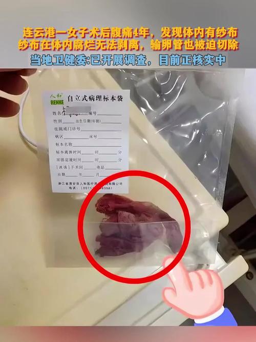 术后体内遗留纱布20天引发感染，女子紧急就医-图3