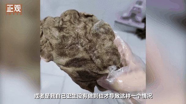 术后体内遗留纱布20天引发感染，女子紧急就医-图1