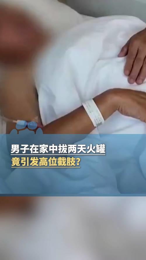 火罐操作不当致高位截瘫,男子居家治疗意外成悲剧-图1 火罐操作不当致高位截瘫,男子居家治疗意外成悲剧-图1