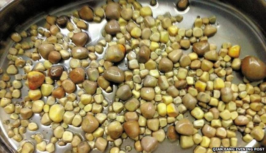 肾结石忽视成隐患，男子健康状况急转直下-图2